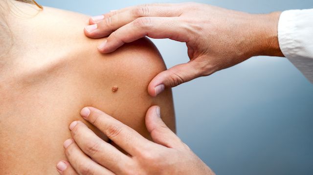 D’après une étude, l’absence de grains de beauté sur votre peau pourrait résulter en des risques plus élevés de cancer de la peau